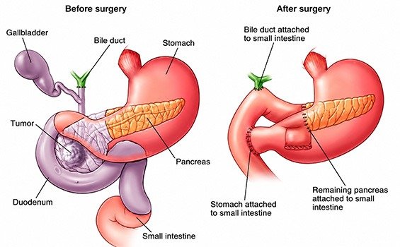 What Types of Pancreatic Cancer Can Be Treated with Surgery?